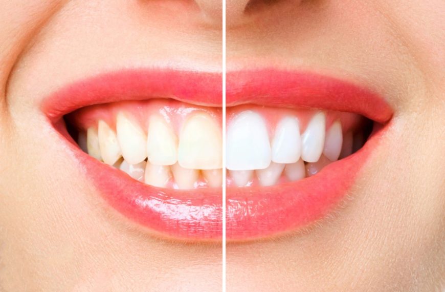 femme-avec-des-dents-propres-et-blanches