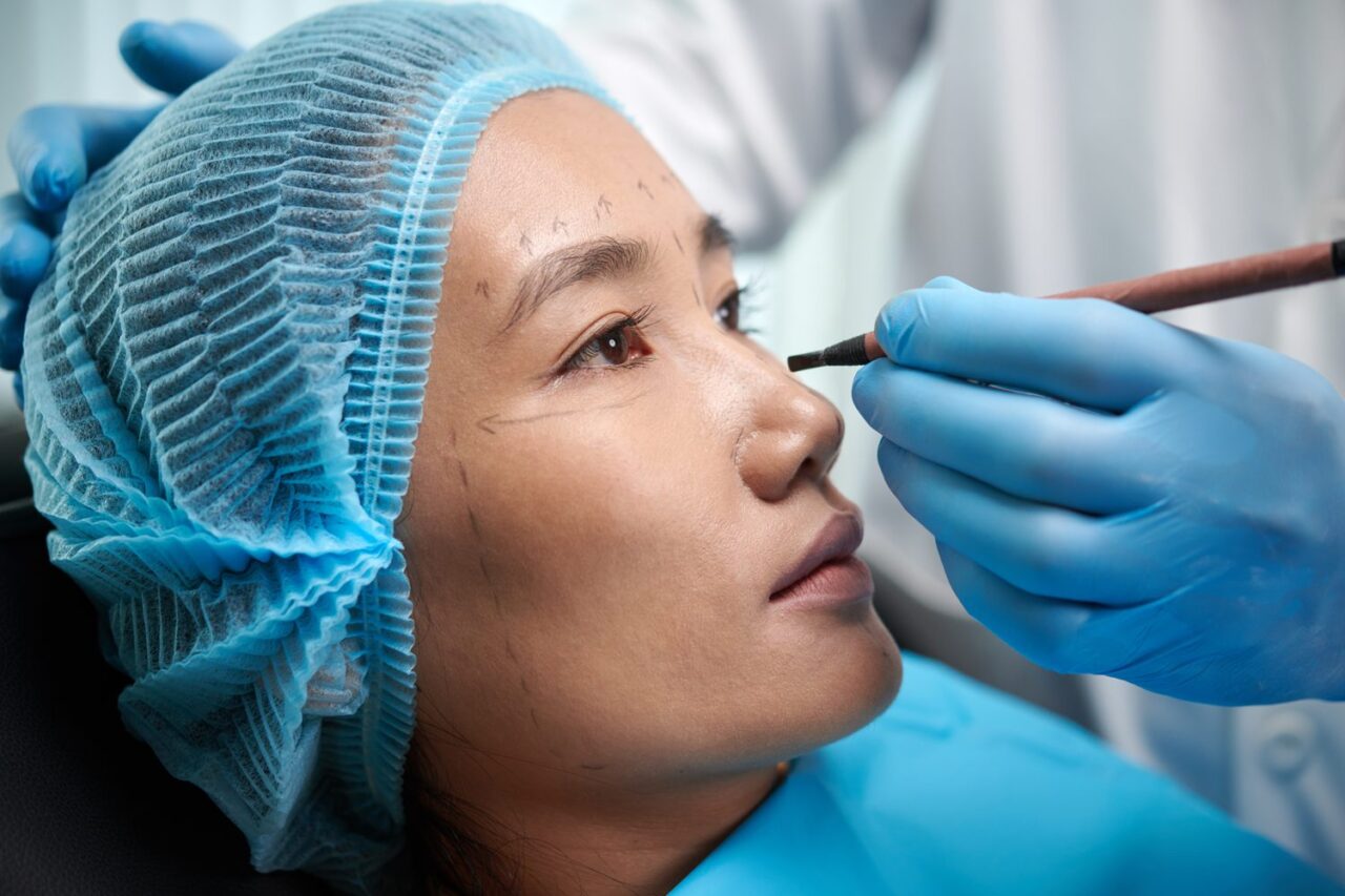Chirurgien dessinant des repères sur le visage d’une patiente avant un lipofilling visage.